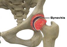 Hip Synovitis