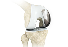 Partial Knee Resurfacing