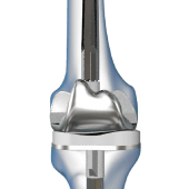 Correction of a Failed Knee Replacement