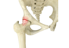 Femoroacetabular Impingement