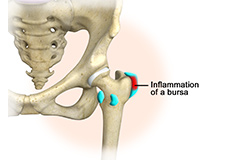 Hip Bursitis