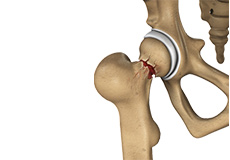 Hip Injury