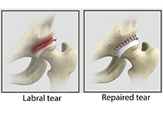 Hip Labral Tear