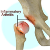 Inflammatory Arthritis of the Hip