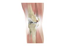 Ligament Injuries