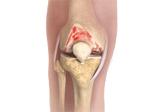 Knee Osteoarthritis