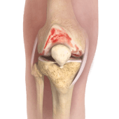 Knee Osteoarthritis