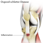 Osgood-Schlatter Disease