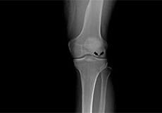 Osteonecrosis of the Knee