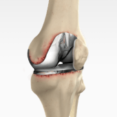 Correction of a Painful Knee Replacement