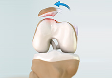 Patellar Dislocation/Patellofemoral Dislocation