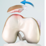 Patellar Dislocation/Patellofemoral Dislocation