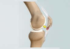 Patellar Tendinitis