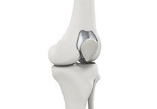 Patellofemoral Knee Replacement