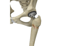 Periprosthetic Hip Fractures