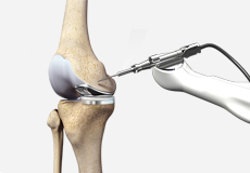 Robotic Assisted Knee Replacement