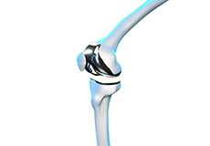 ROSA Robotic Total Knee Replacement
