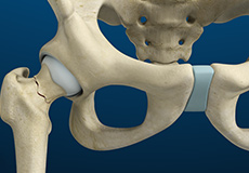 Subtrochanteric Hip Fracture