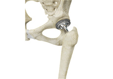 Total Hip Replacement