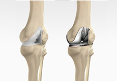 What is New in Knee Replacement
