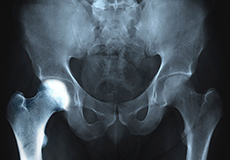 Transient Osteoporosis of the Hip