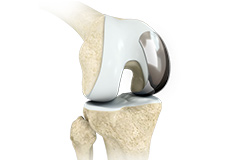 Unicondylar knee Replacement