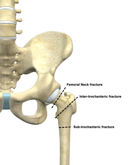 Hip Fracture Anatomy