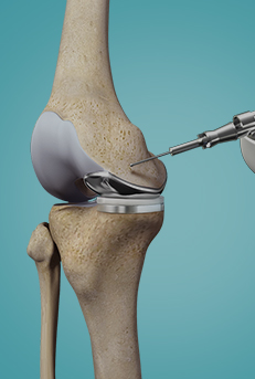 Robotic Assisted Knee Replacement